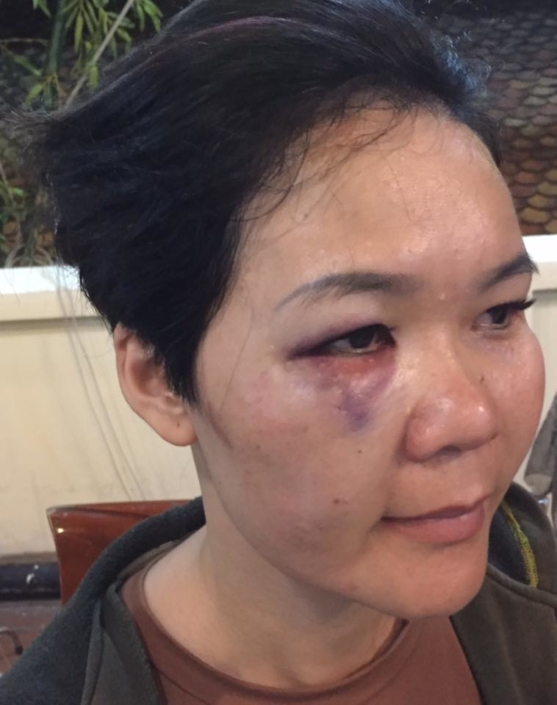 Le My Hanh injury May 2